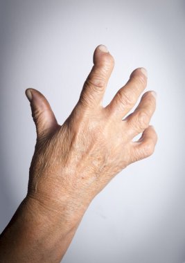 Romatoid artrit deforme el