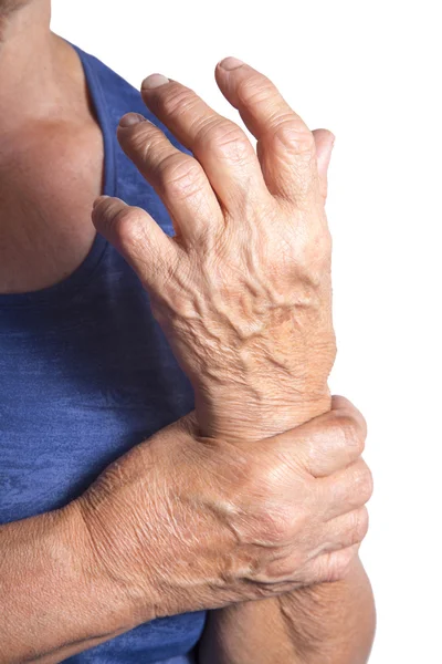 Hand vervormd van reumatoïde artritis — Stockfoto