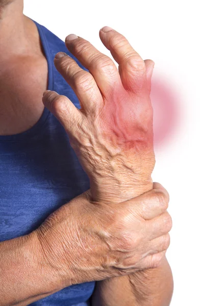 Mano deformata da artrite reumatoide — Foto Stock
