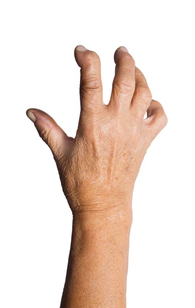 Hand durch rheumatoide Arthritis deformiert — Stockfoto