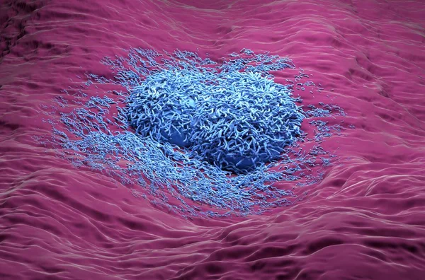 Liver cancer hepatoma blue color realistic side view 3d illustration
