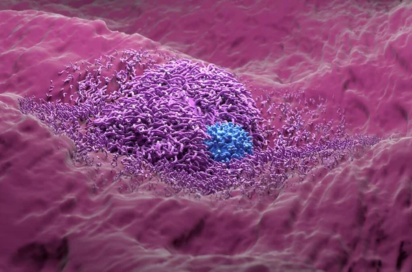 T细胞现实阴道镜下肝癌3D例分析 — 图库照片