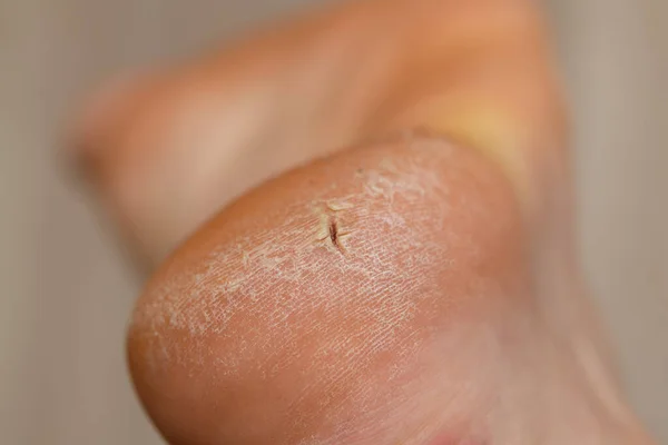 Τακούνι Ραγισμένο Δέρμα Στο Πόδι Του Ανθρώπου — Φωτογραφία Αρχείου