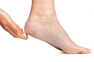 İyi bakımlı ayaklarda kurumuş cilt bakımı ve cilt ve ayaklar için kremli topuklar.