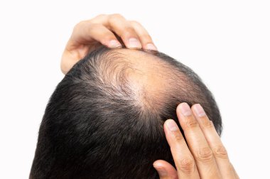 Saç dökülmesinden endişelenen orta yaşlı bir adam. Kellik