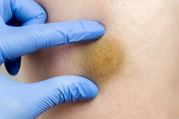 Close Image Doctor Checking Hematoma Skin Blow Leg — Stock Photo, Image