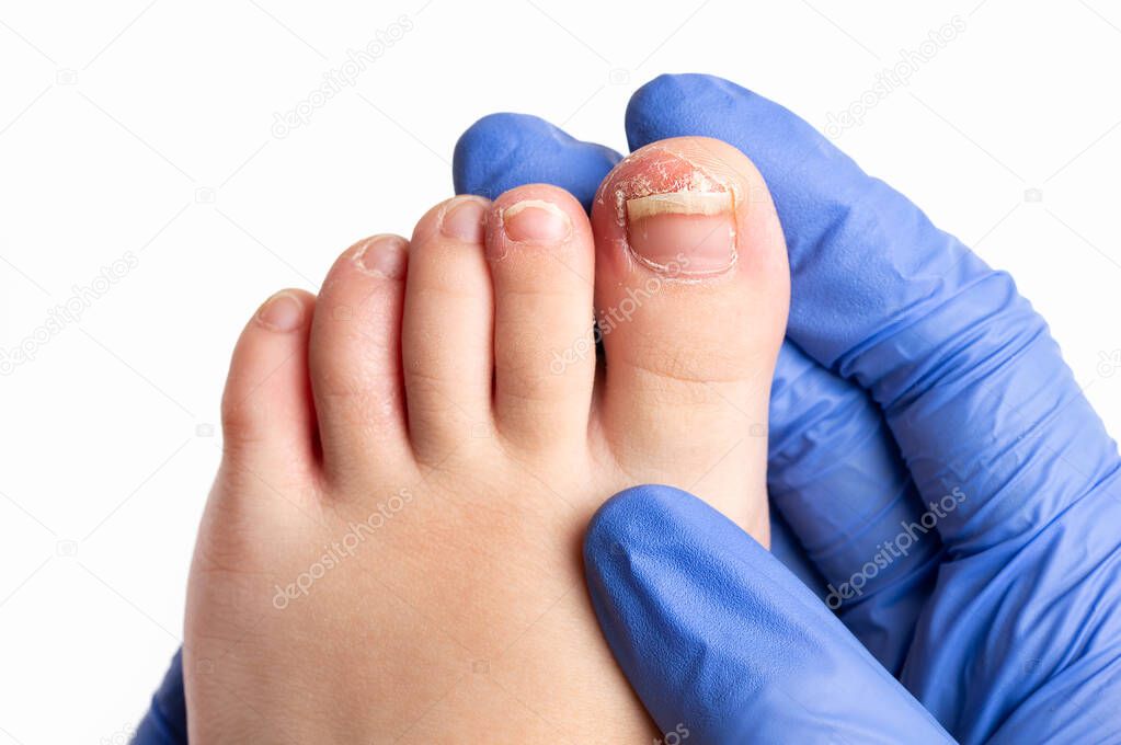 Close-up image of doctor checking the left toe of a child suffering from nail fungus isolated on white