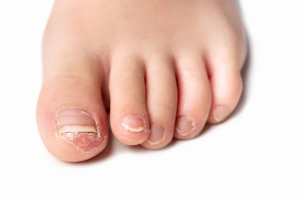 Передний Угол Снимка Пальца Ребенка Грибковой Инфекцией Ногтей Белом Фоне — стоковое фото