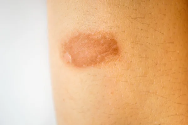 Wound of burn in the skin — Stock Photo, Image