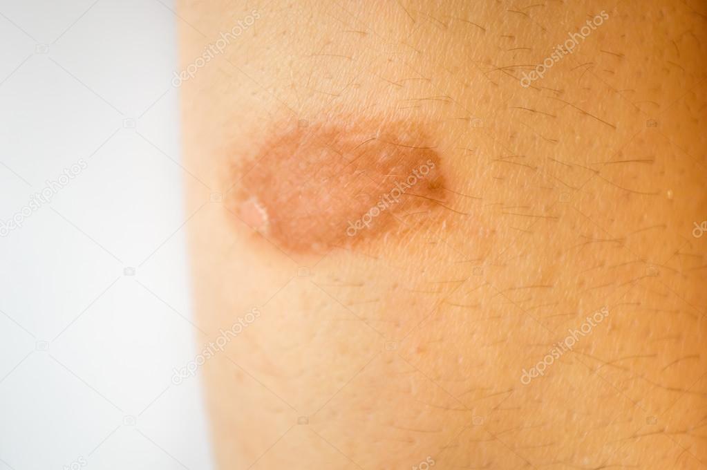 wound of burn in the skin