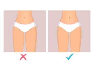 İhmal edilmiş bikini bölgesi olan iç çamaşırlı bir kadın. Külotun altındaki uzun saçlar. Öncesinde ve sonrasında tüy dökücü iki resim ve evet ve hayır işareti.