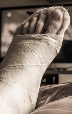 Alçı içinde kırık bacak