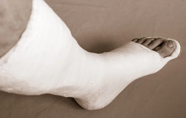 Σπασμένο πόδι στο γύψο — Φωτογραφία Αρχείου