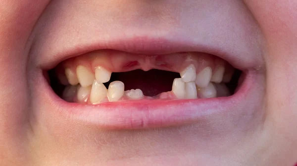 Boca da criança com dentes em mudança — Fotografia de Stock