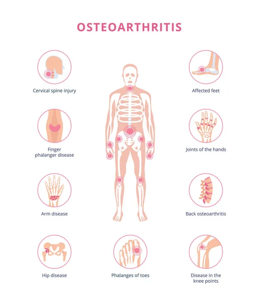 Lékařské schéma osteoartritidy poškození kloubů, ploché vektorové ilustrace izolované. — Stockový vektor