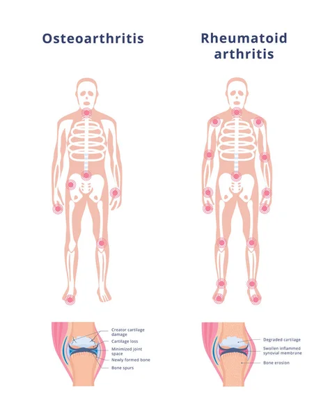 Banner av artros och reumatoid artrit platt vektor illustration. — Stock vektor