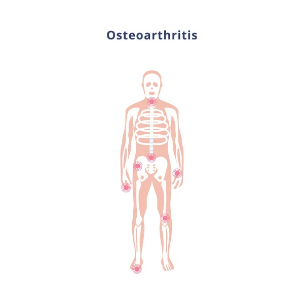 Diagrama del cuerpo con daño articular por osteoartritis, ilustración vectorial plana. — Archivo Imágenes Vectoriales