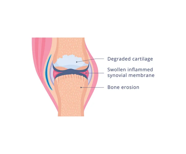 Διάγραμμα της άρθρωσης του γόνατος με οστεοαρθρίτιδα, επίπεδη διανυσματική απεικόνιση απομονωμένη. — Διανυσματικό Αρχείο
