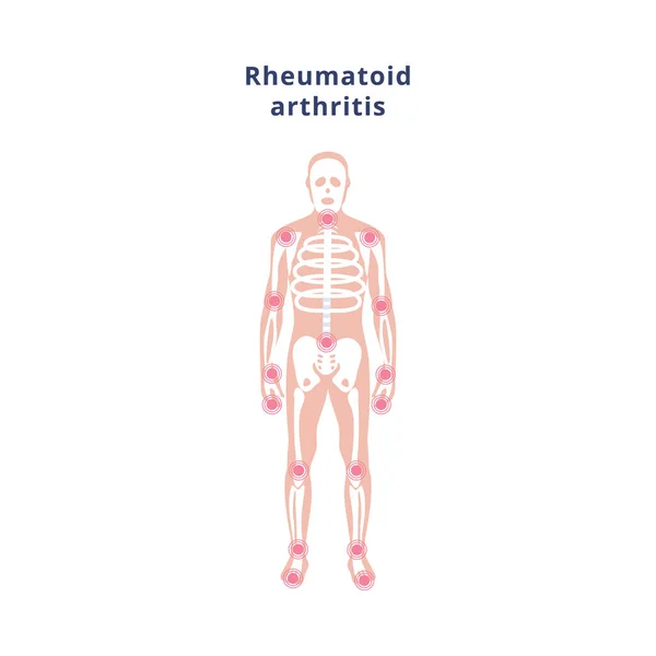 Poster with human skeleton with sources of pain disease rheumatoid arthritis — Stock Vector