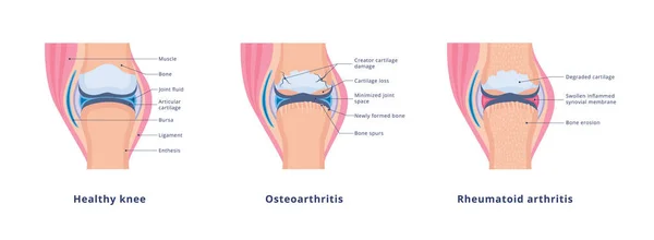 A térd osteoarthritis stádiumainak infografikája, izolált lapos vektor illusztráció. — Stock Vector