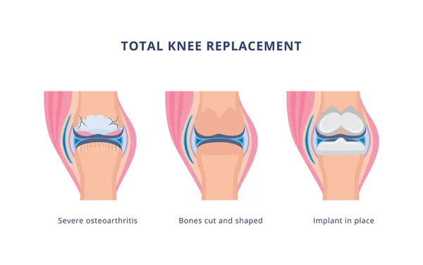 Cirugía total de reemplazo de rodilla, ilustración vectorial plana aislada. — Vector de stock