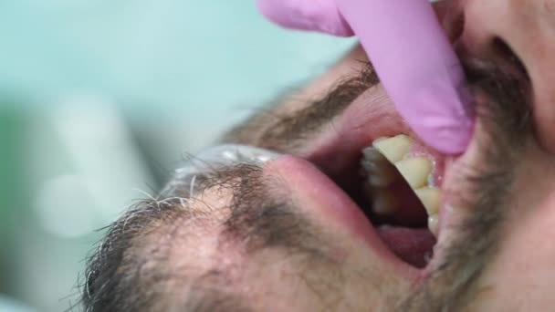 Middle-aged man with mustache and beard at the dentists appointment — Stockvideo