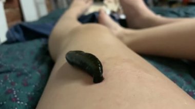 Tıbbi sülük bacağa kan emer.