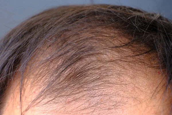 Young Man Baldness Health Medicine Concept — Stock Photo, Image