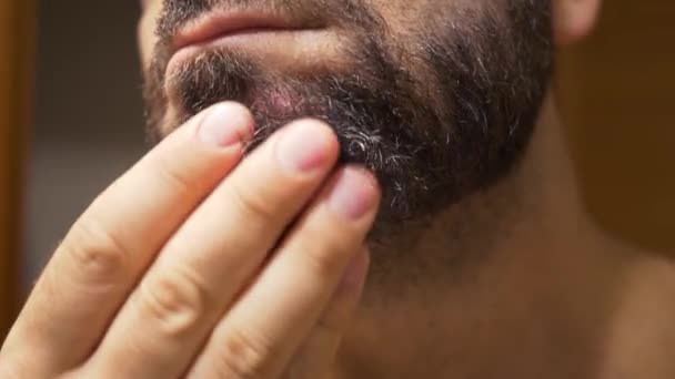 髭面に脂漏性皮膚炎の男のあごの詳細 乾燥肌が剥がれ かゆみや汚れの原因となります — ストック動画