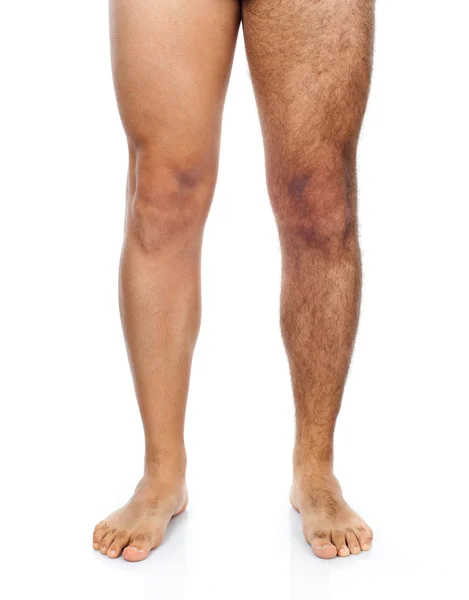 Male hair removal on legs — Stock Photo, Image