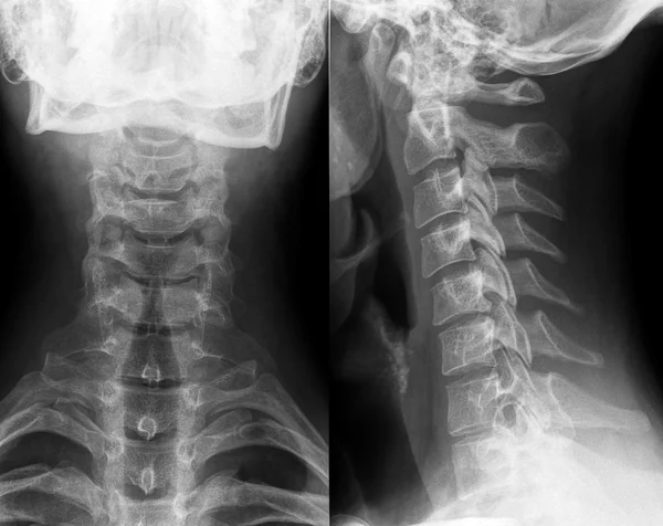 Røntgen af nakke og halshvirvelsøjle - Stock-foto