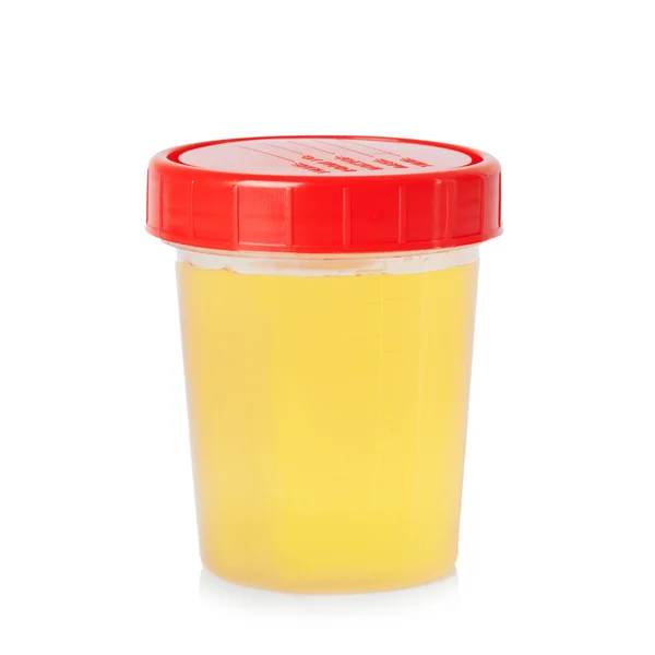 Urine sample in container — Stock Photo, Image