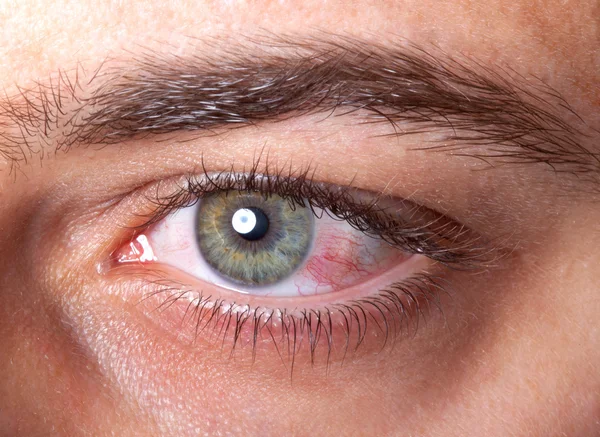 Irritated red bloodshot eye — Stock Photo, Image