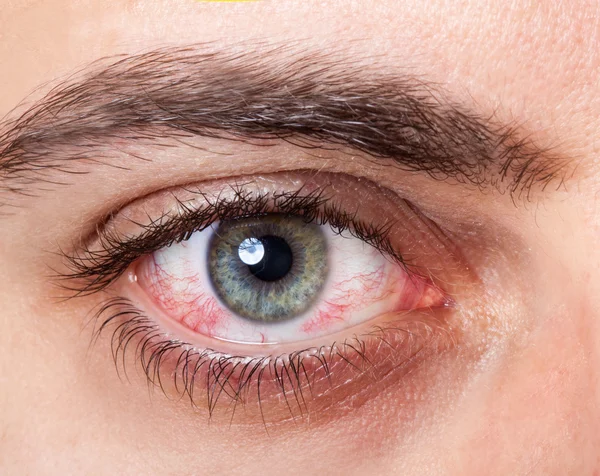 Irritated red bloodshot eye Stock Image