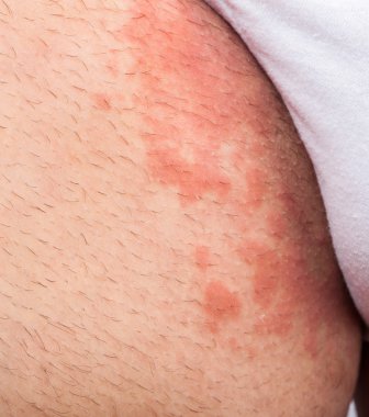 Eczema groin clipart