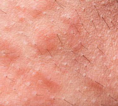 Eczema atopic dermatitis clipart