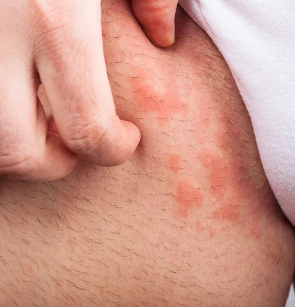 Virilha eczema — Fotografia de Stock
