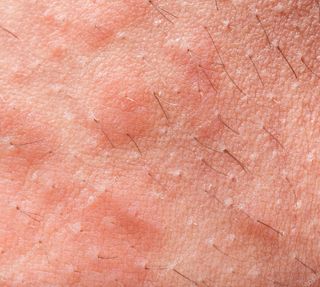 Lista 104 Imagen De Fondo Fotos De Dermatitis Atópica En Adultos Cena