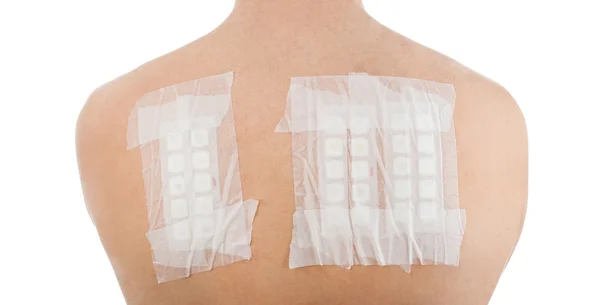 Hud allergi Patch Test på Bacck — Stockfoto