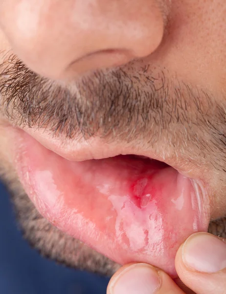 Lower lip with aphtha — Stock Photo, Image