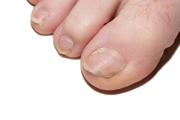 Nail Human Toenail Fungus Damaged Nail Nail Disease — Stock Photo, Image