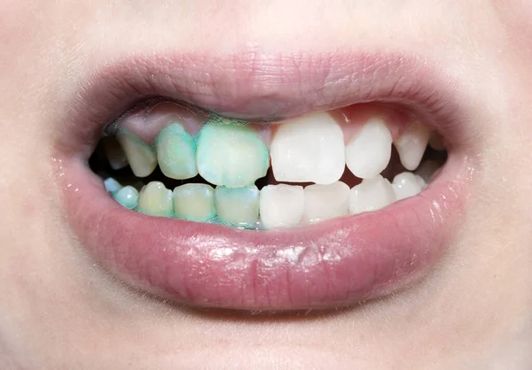 Enjuague Bucal Placa Dental Dientes Dientes Antes Después Cepillarse Blanquear —  Fotos de Stock