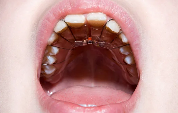 Zęby Leczenie Stomatologiczne Otwarte Usta Płytką Ustawiania Zębów Dziecko Złymi — Zdjęcie stockowe