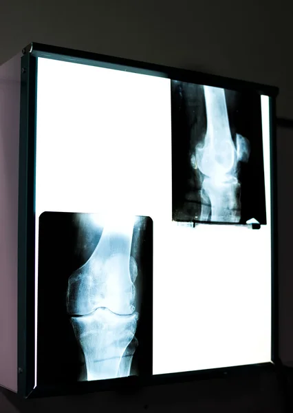 Knee X-ray — Stock Photo, Image