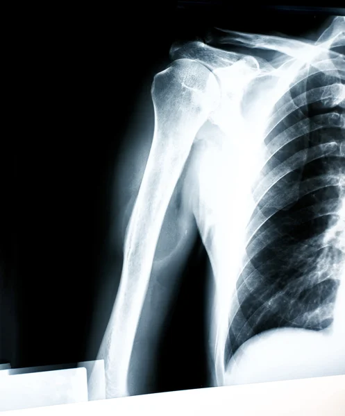 X-ray van schouder — Stockfoto