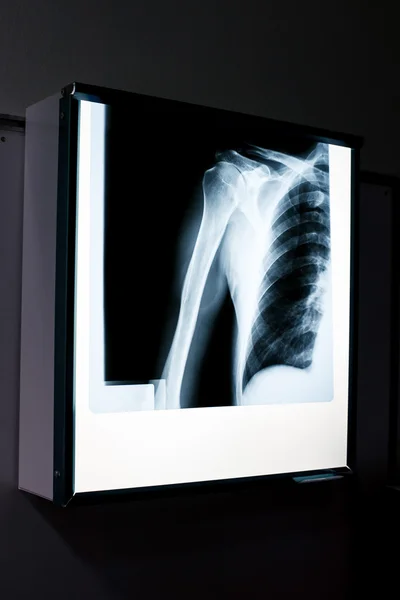 X-ray of shoulder — Stock Photo, Image