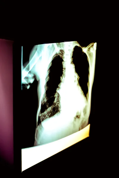 Lung x-ray — Stock Photo, Image
