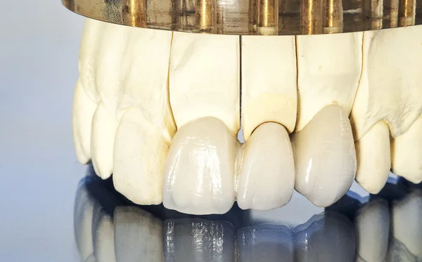 Ceramiczne korony dentystyczne bez metalu — Zdjęcie stockowe