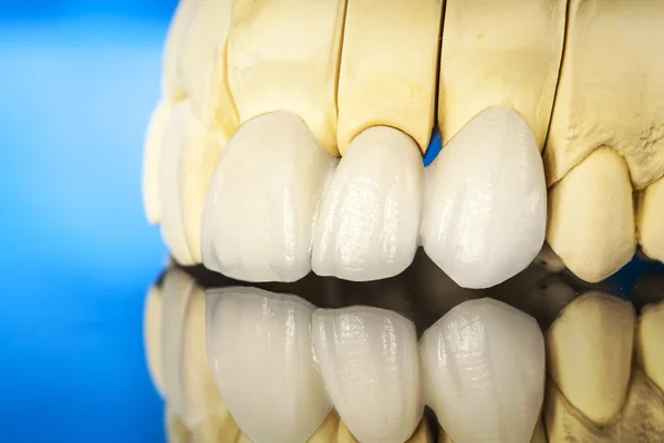 Corone dentali in ceramica senza metallo — Foto Stock