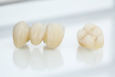 Metalsiz seramik diş kaplamaları